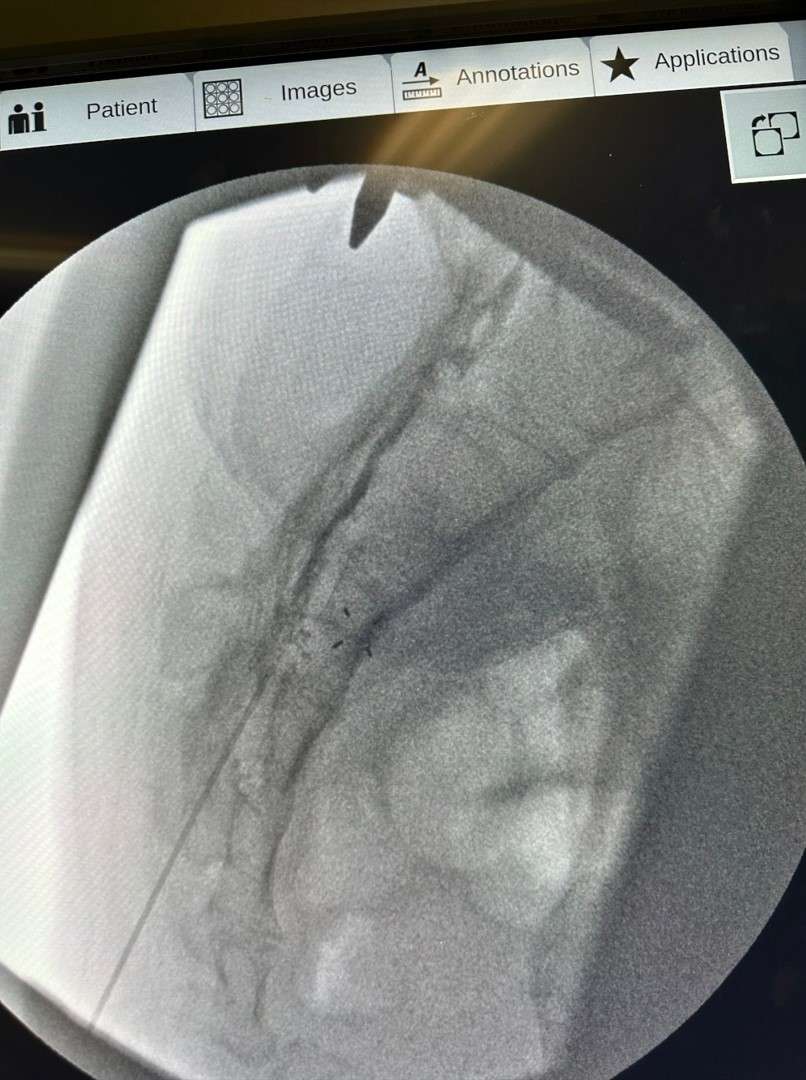 Lumbar Epidural Steroid Injections