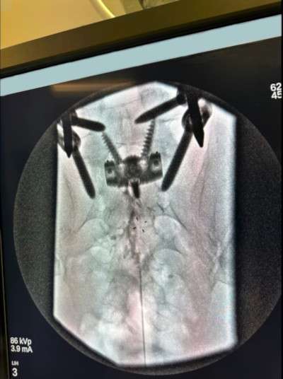 Lumbar Epidural Steroid Injections